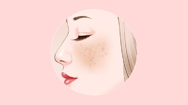 女性黄褐斑中药方子
