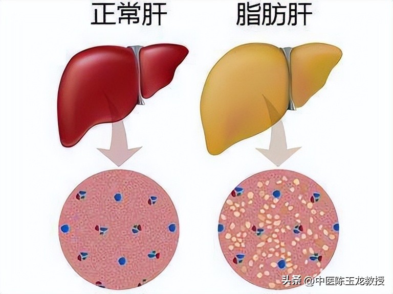 枳术汤治疗肥胖_中医减肥祖方_能减肥的中药配方